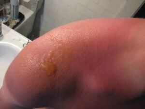 Blistering sunburn after a day without sunscreen